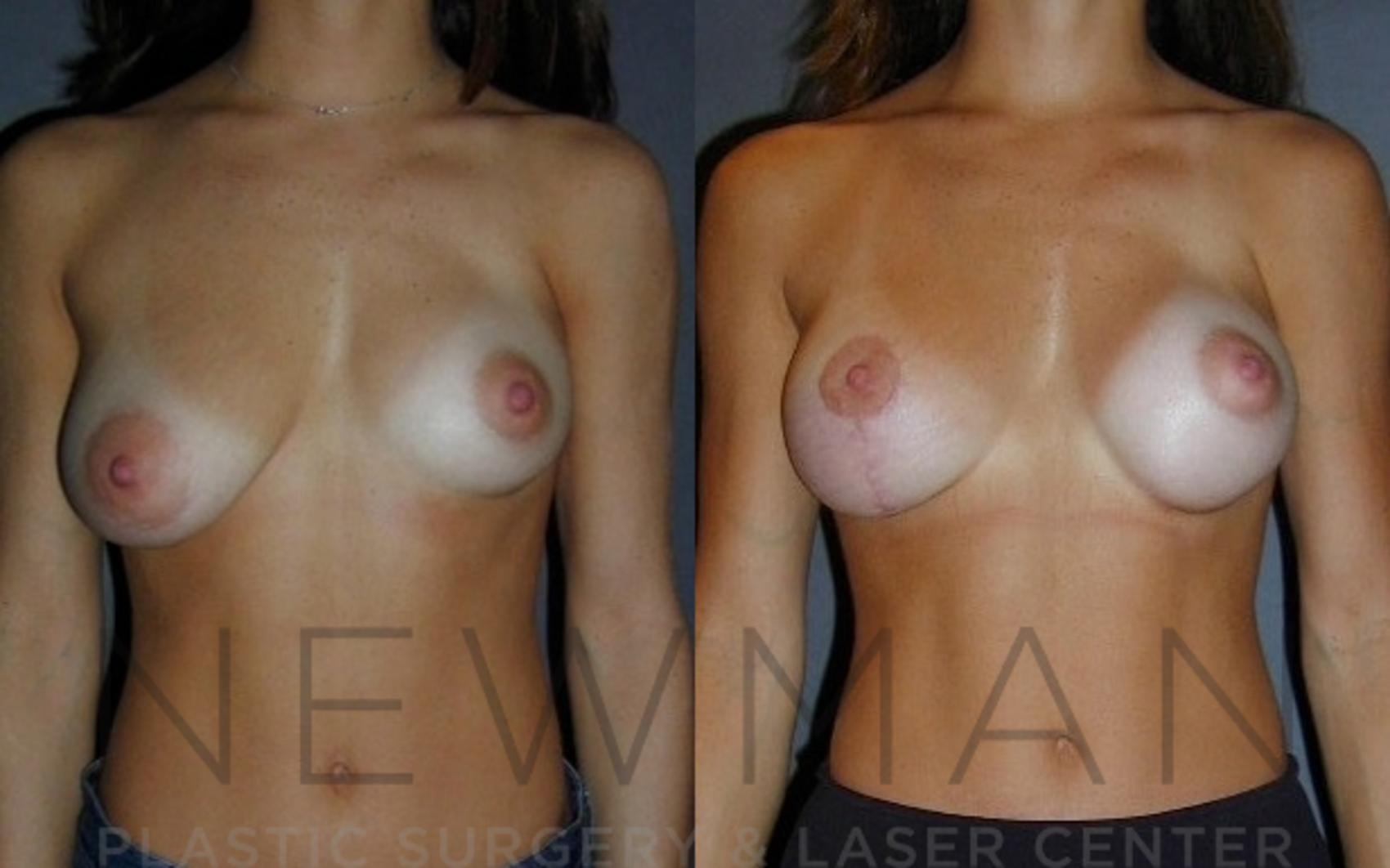 Before & After Breast Asymmetry Case 73 Front View in Westchester County & Long Island, NY