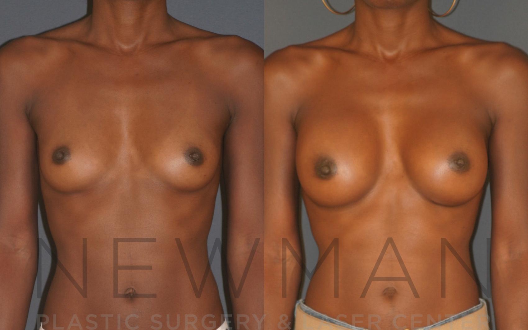 Before & After Breast Augmentation Case 12 Front View in Westchester County & Long Island, NY