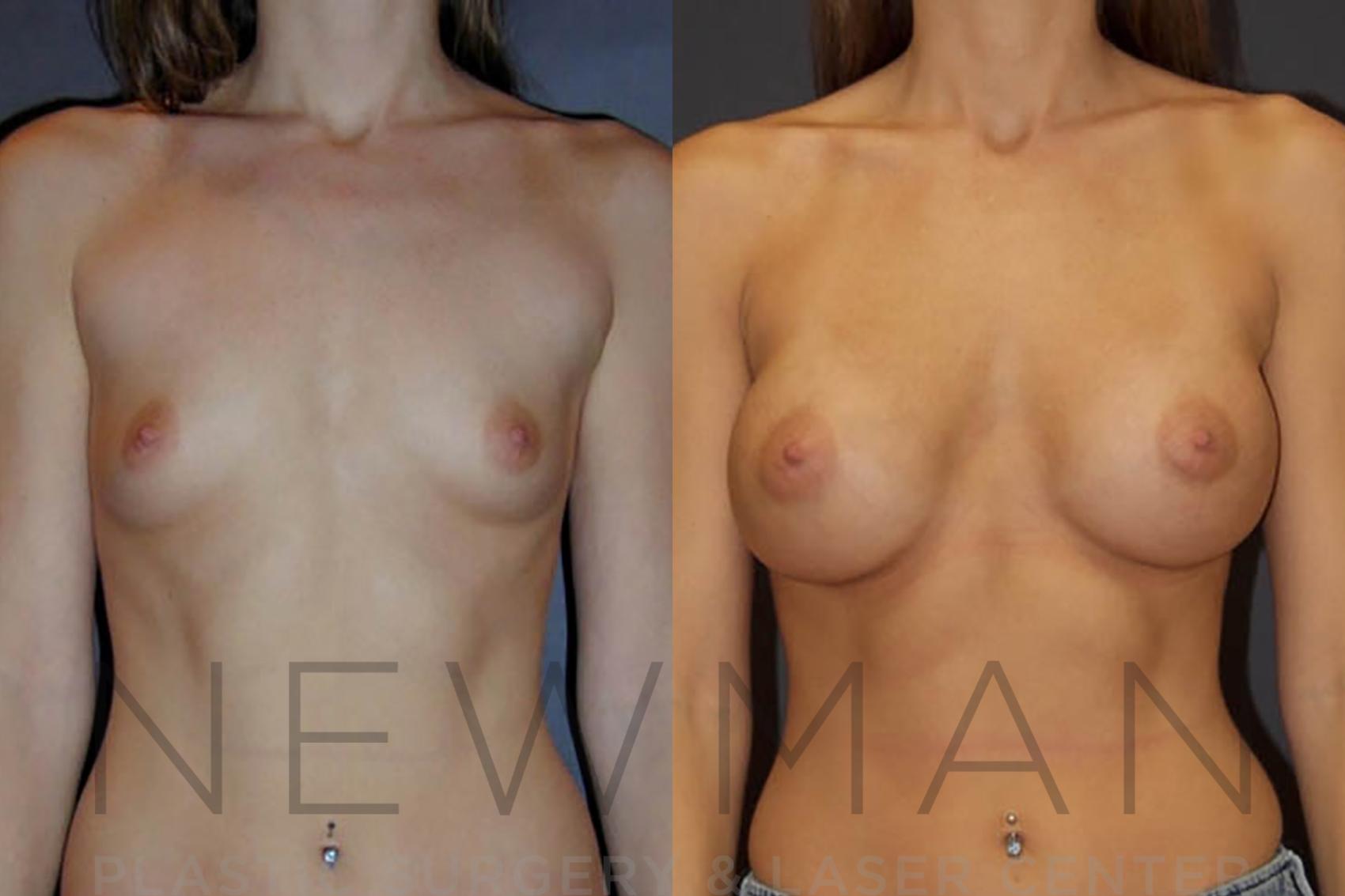 Before & After Breast Augmentation Case 14 Front View in Westchester County & Long Island, NY