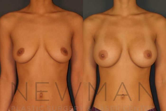 Before & After Breast Augmentation Case 16 Front View in Westchester County & Long Island, NY