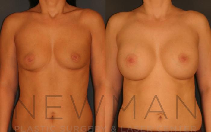 Before & After Breast Augmentation Case 19 Front View in Westchester County & Long Island, NY