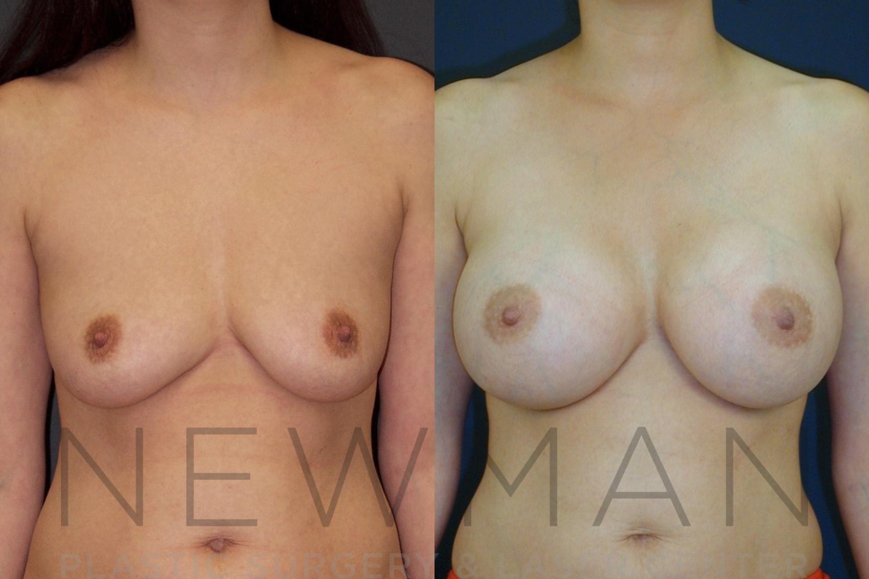Before & After Breast Augmentation Case 22 Front View in Westchester County & Long Island, NY