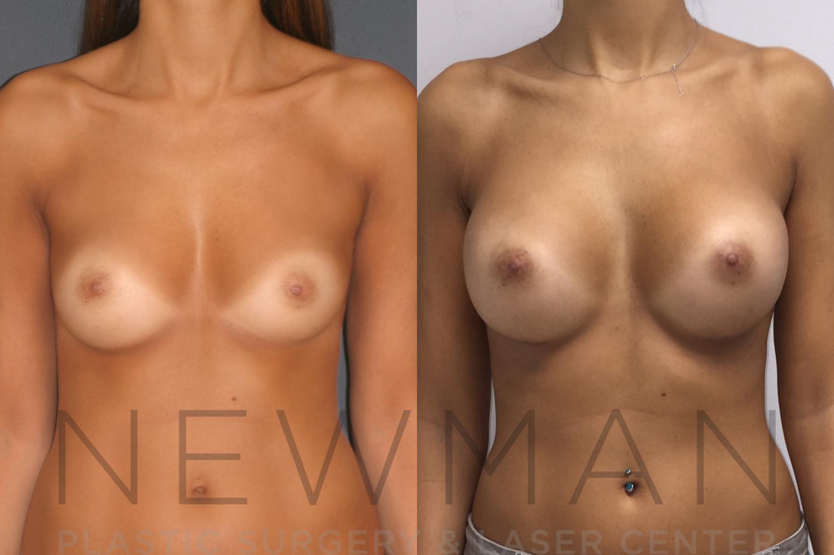 Before & After Breast Augmentation Case 25 Front View in Westchester County & Long Island, NY