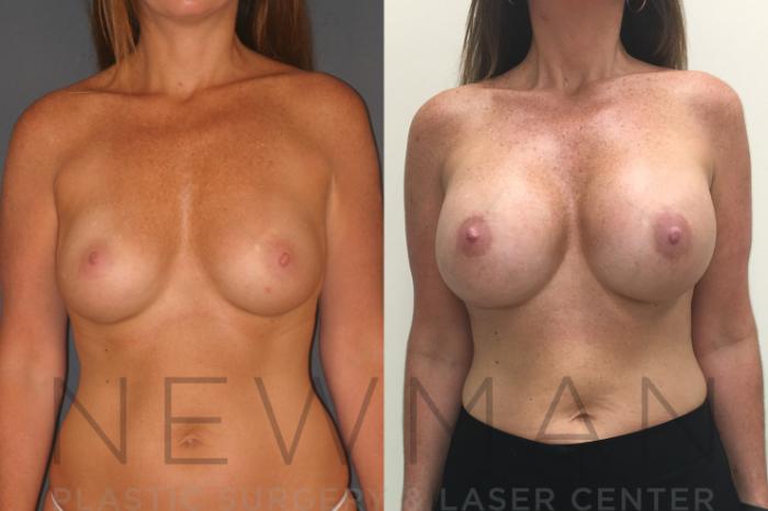 Before & After Breast Augmentation Case 26 Front View in Westchester County & Long Island, NY