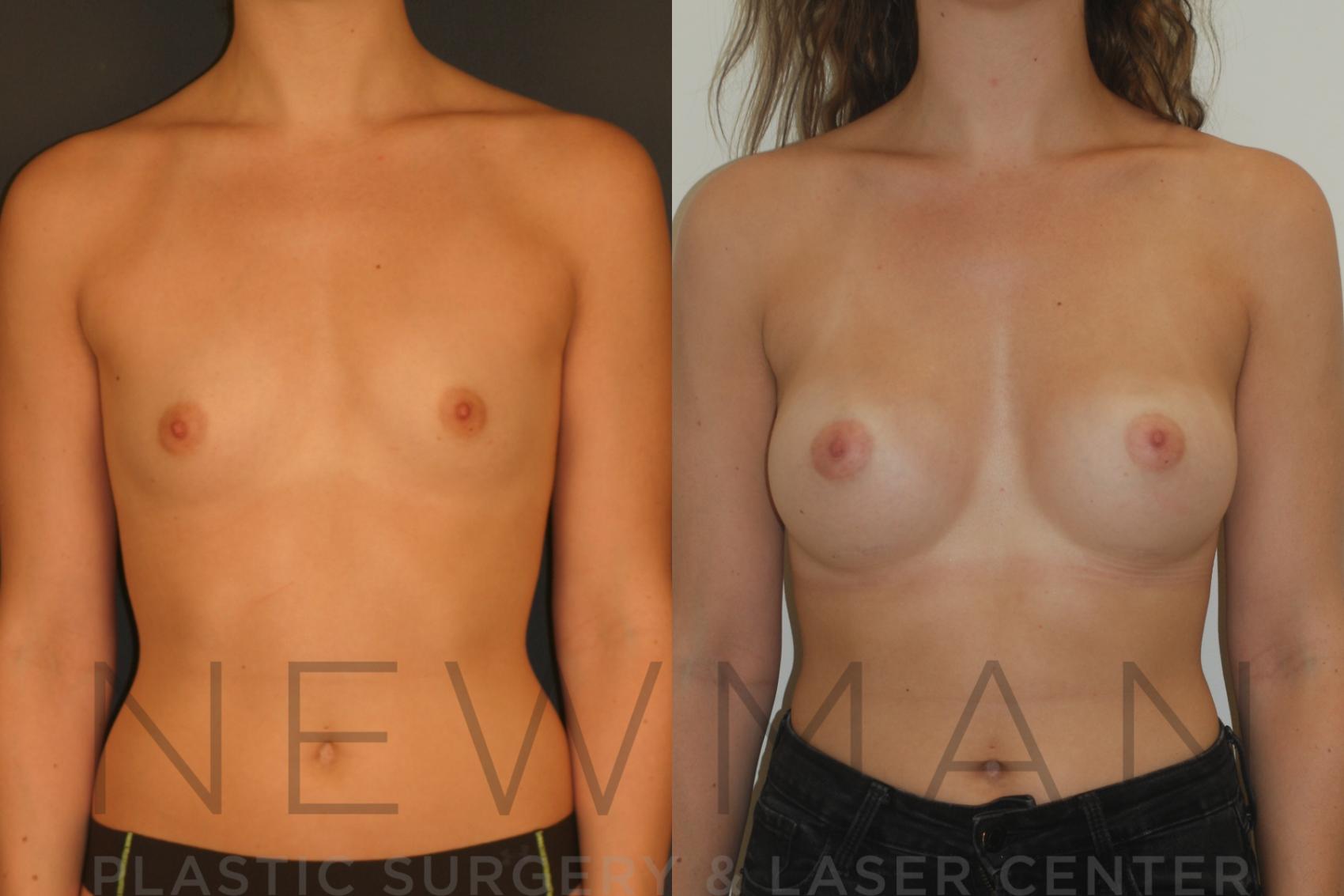 Before & After Breast Augmentation Case 7 Front View in Westchester County & Long Island, NY