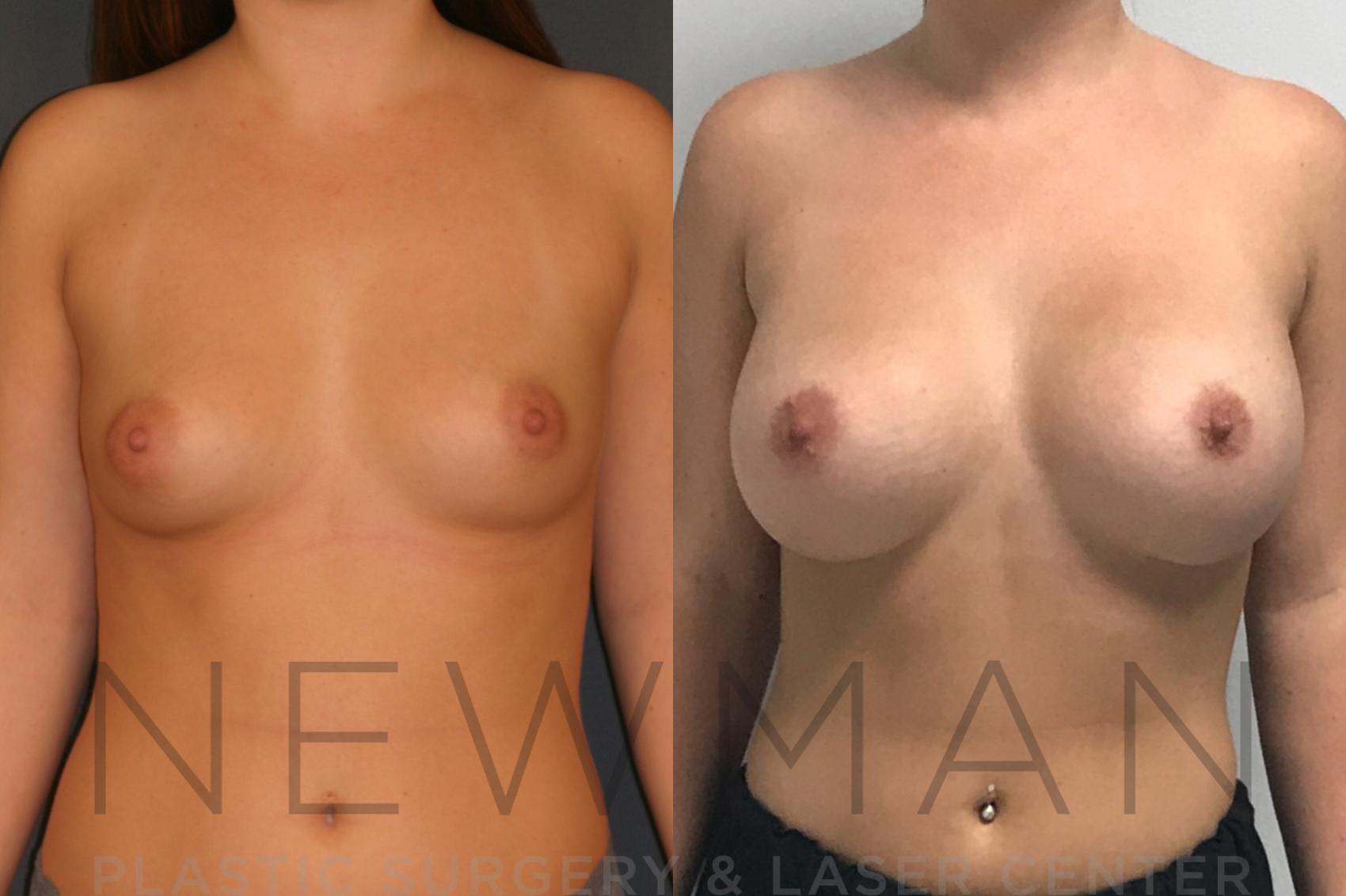 Before & After Breast Augmentation Case 9 Front View in Westchester County & Long Island, NY