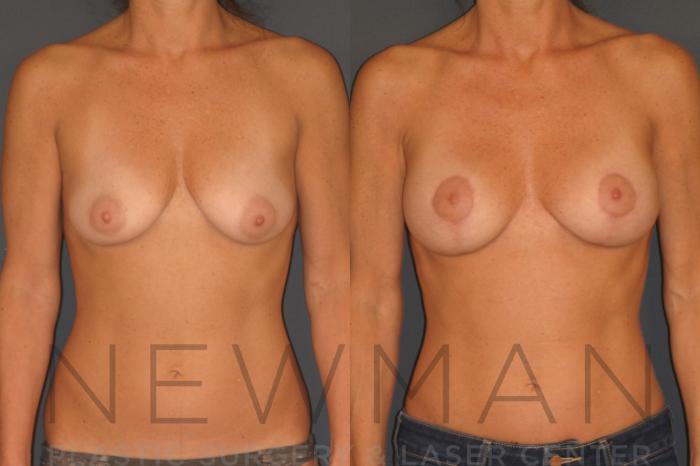 Before & After Breast Augmentation Case 123 Front View in Westchester County & Long Island, NY