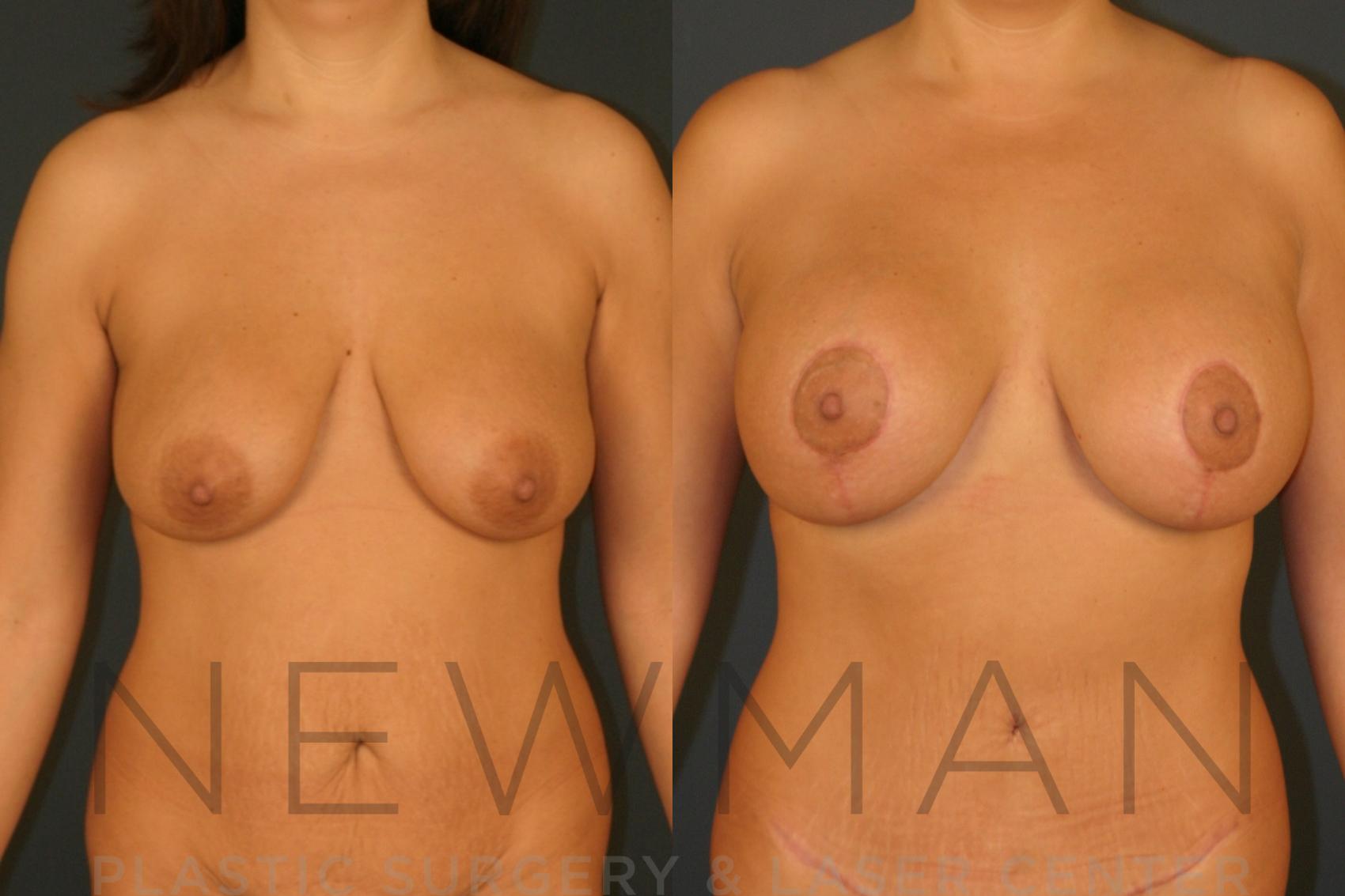 Before & After Breast Lift with Augmentation Case 125 Front View in Westchester County & Long Island, NY