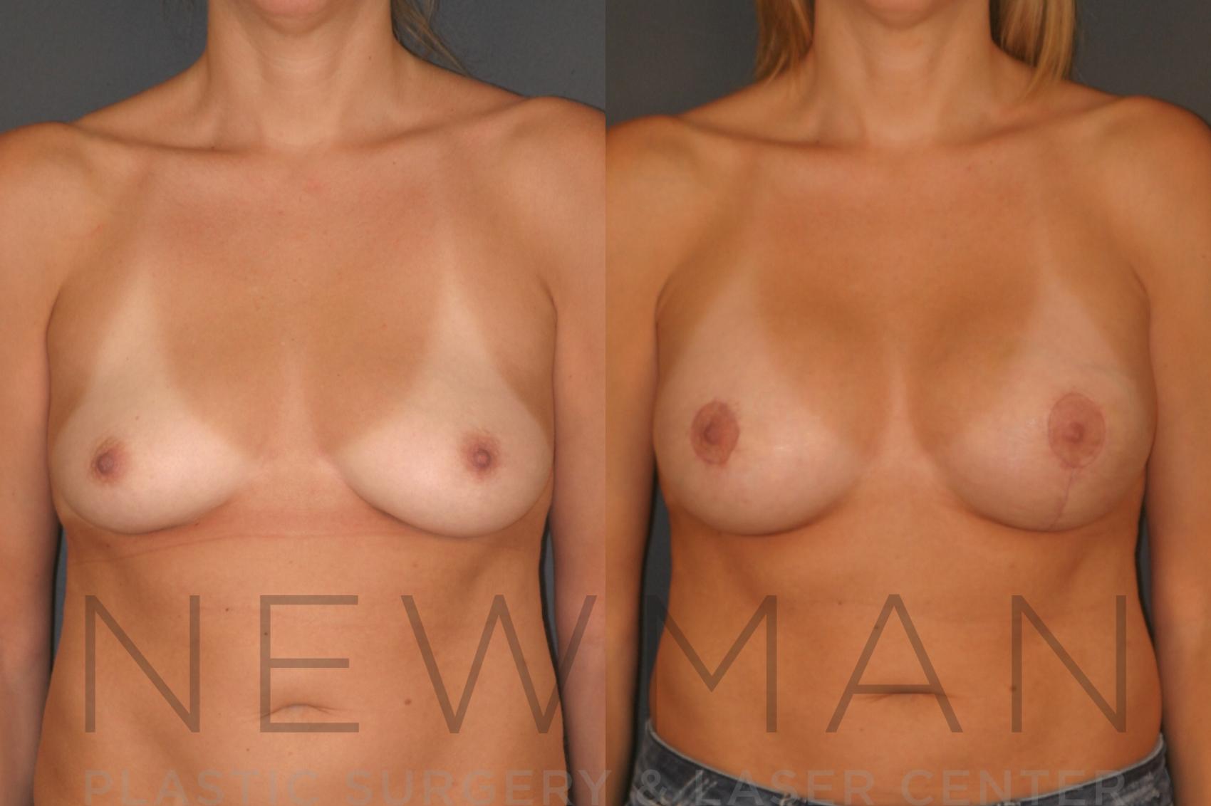 Before & After Breast Lift with Augmentation Case 131 Front View in Westchester County & Long Island, NY