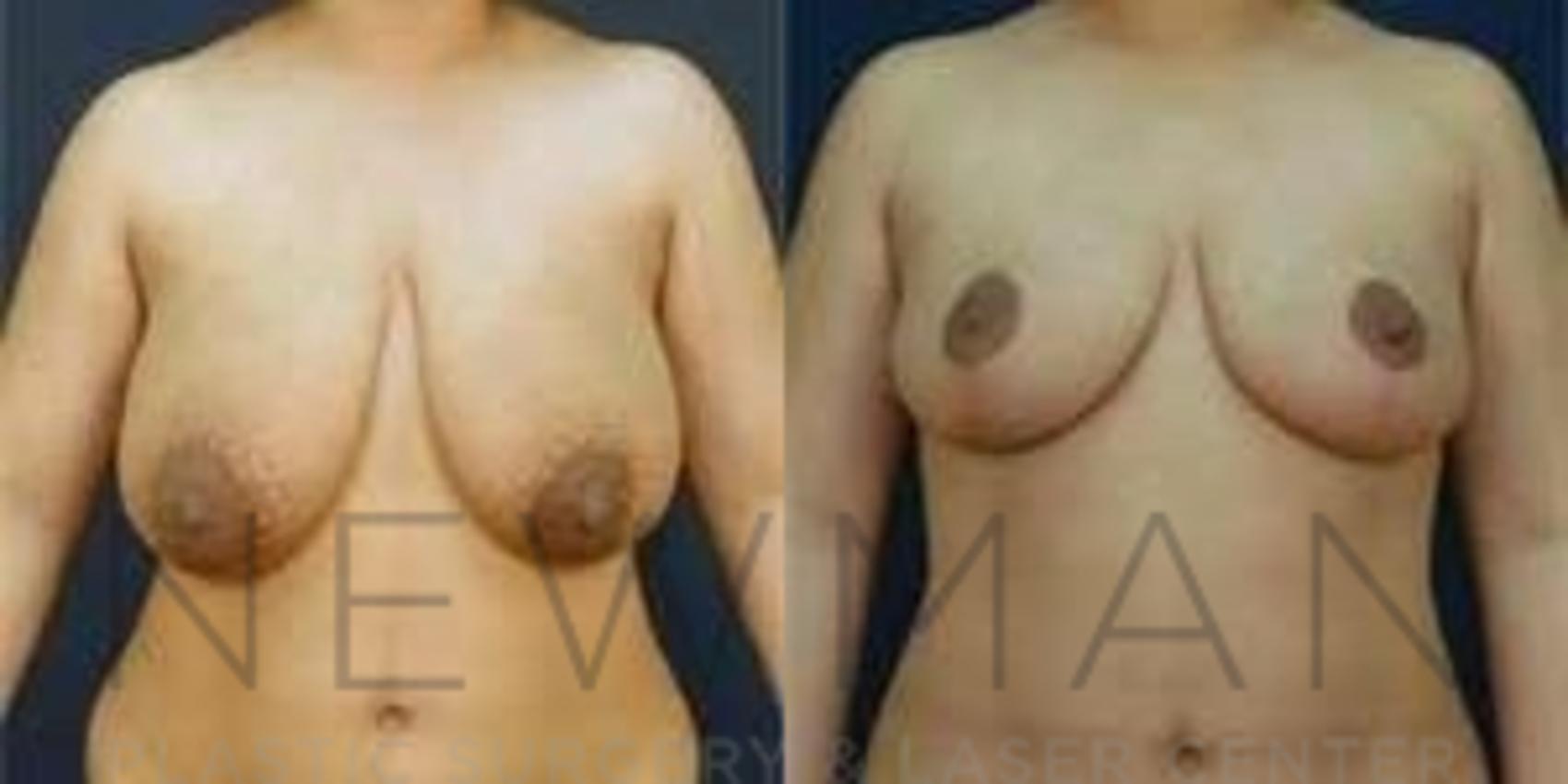 Before & After Breast Reduction Case 46 Front View in Westchester County & Long Island, NY