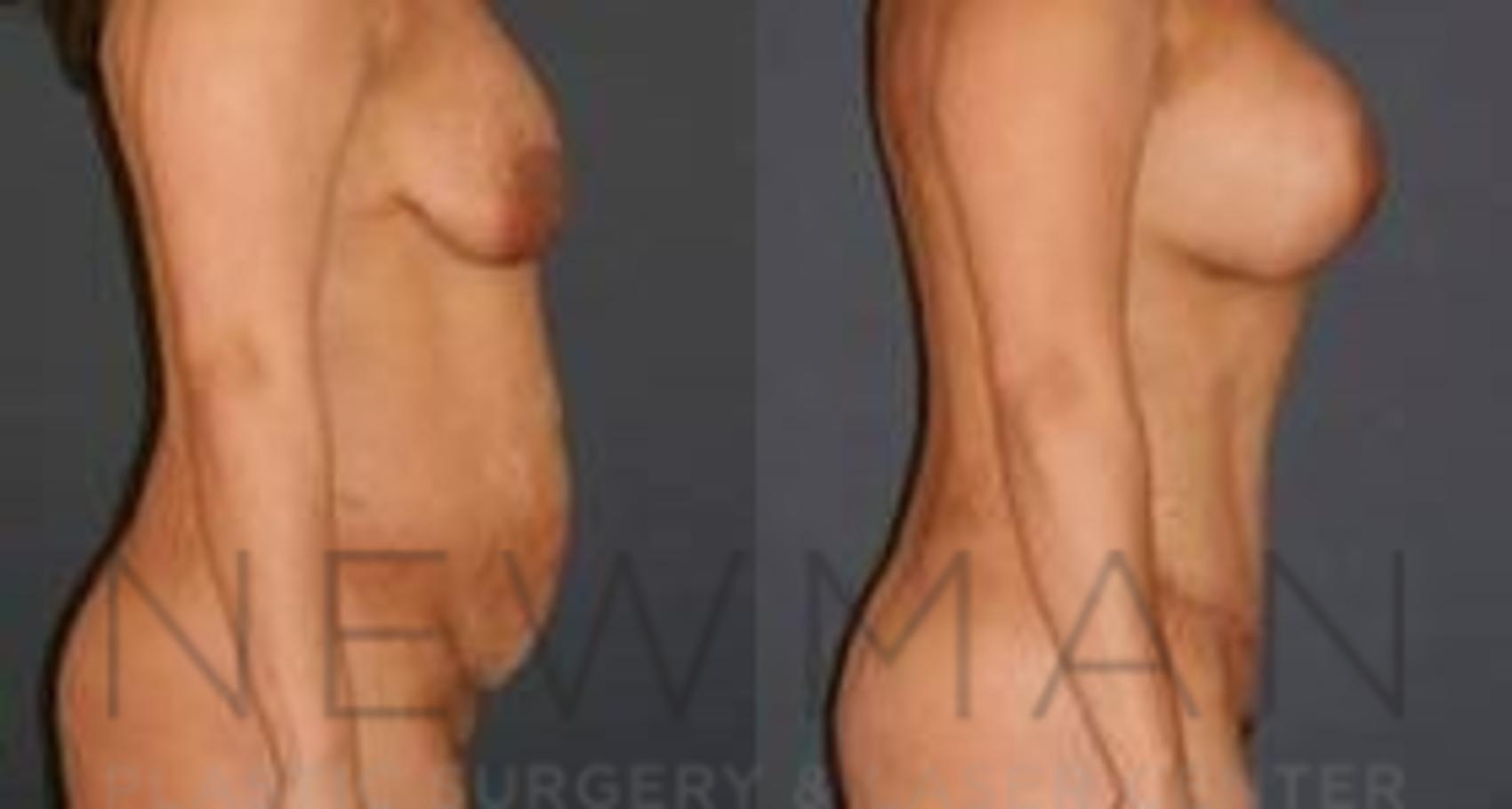 Before & After Tummy Tuck Case 31 Right Side View in Westchester County & Long Island, NY
