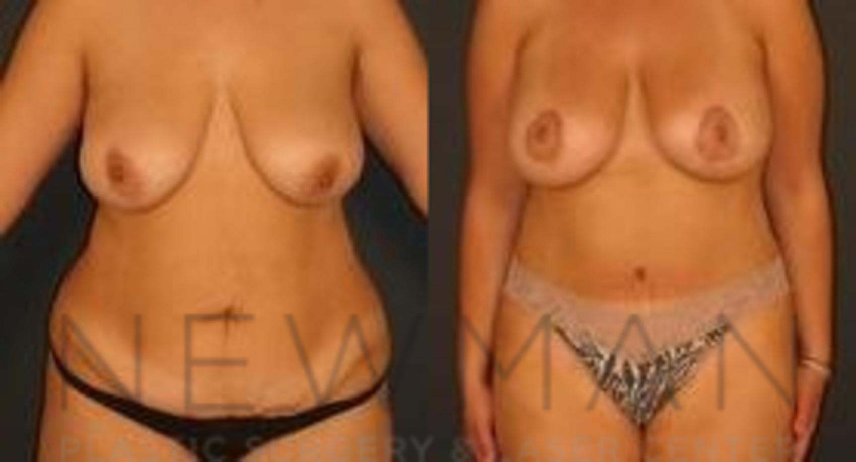 Before & After Tummy Tuck Case 34 Front View in Westchester County & Long Island, NY