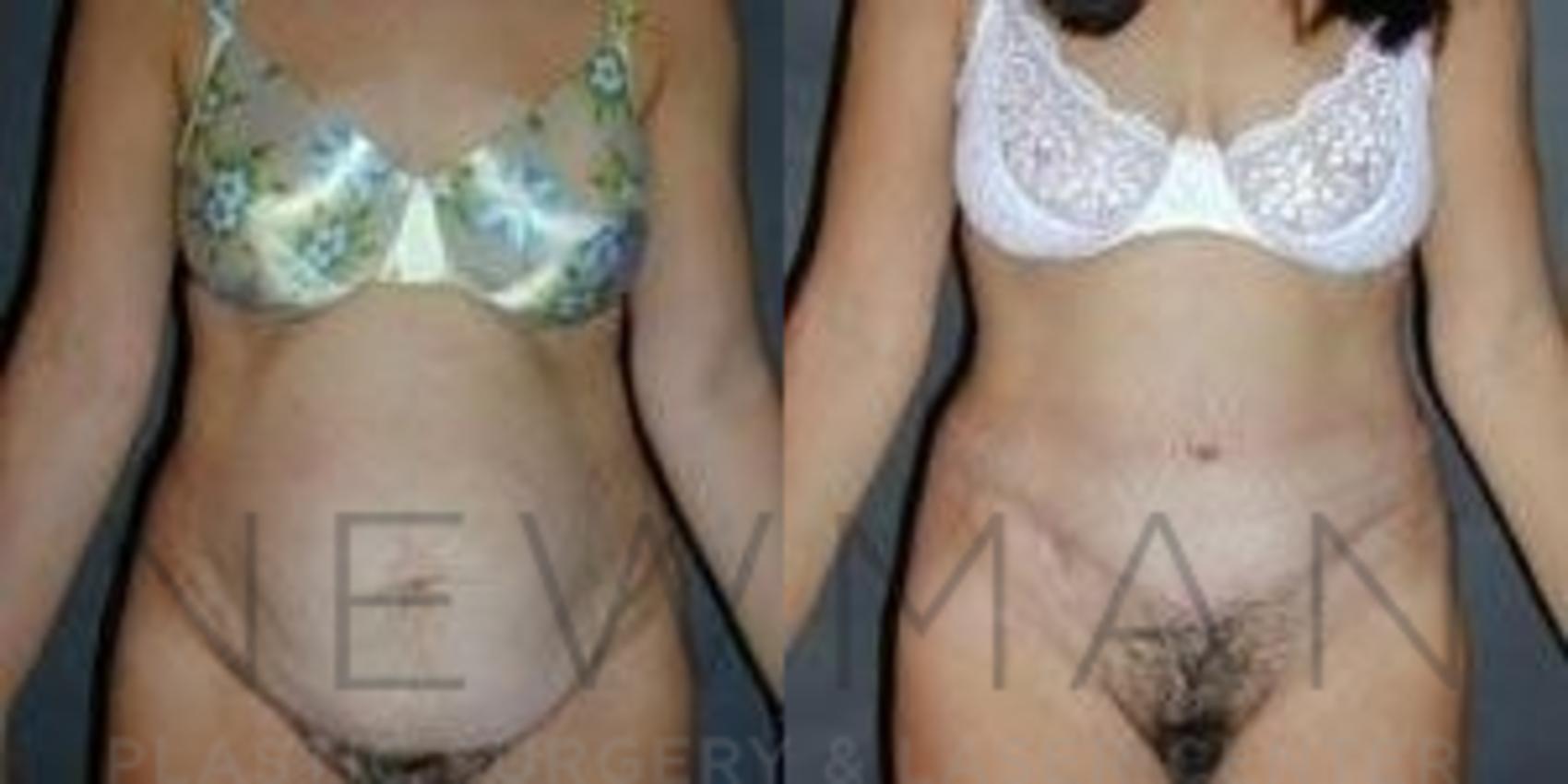 Before & After Tummy Tuck Case 37 Front View in Westchester County & Long Island, NY