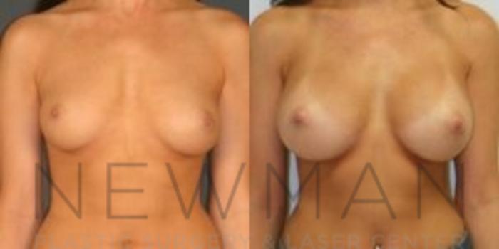 Before & After Breast Asymmetry Case 68 Front View in Westchester County & Long Island, NY