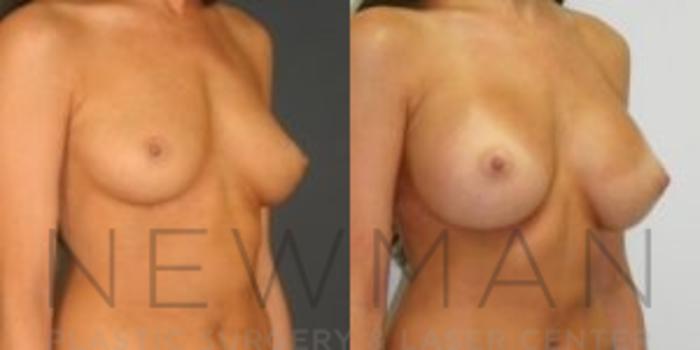 Before & After Breast Asymmetry Case 68 Right Oblique View in Westchester County & Long Island, NY
