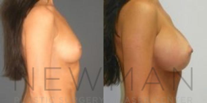 Before & After Breast Asymmetry Case 68 Right Side View in Westchester County & Long Island, NY