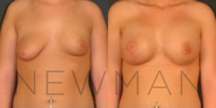 Before & After Breast Asymmetry Case 69 Front View in Westchester County & Long Island, NY