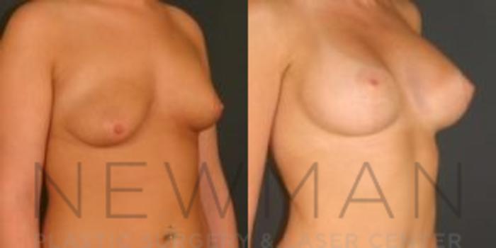 Before & After Breast Asymmetry Case 69 Right Oblique View in Westchester County & Long Island, NY