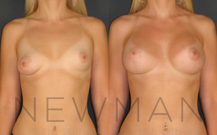 Before & After Breast Asymmetry Case 70 Front View in Westchester County & Long Island, NY
