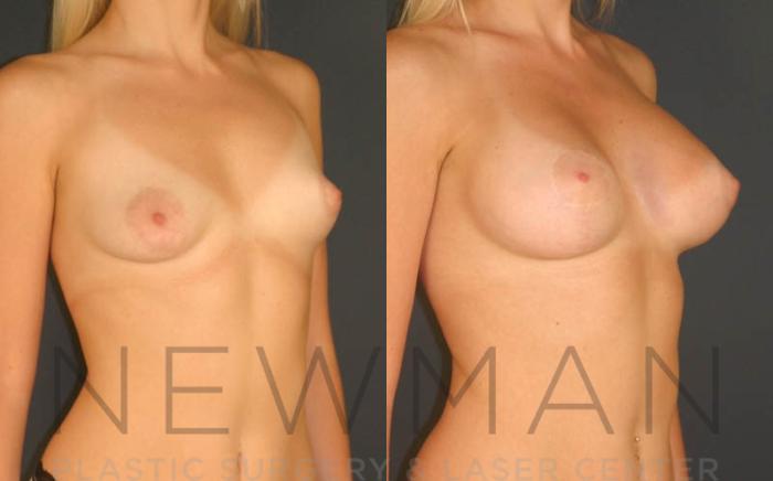 Before & After Breast Asymmetry Case 70 Right Oblique View in Westchester County & Long Island, NY