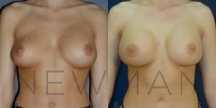 Before & After Breast Asymmetry Case 71 Front View in Westchester County & Long Island, NY