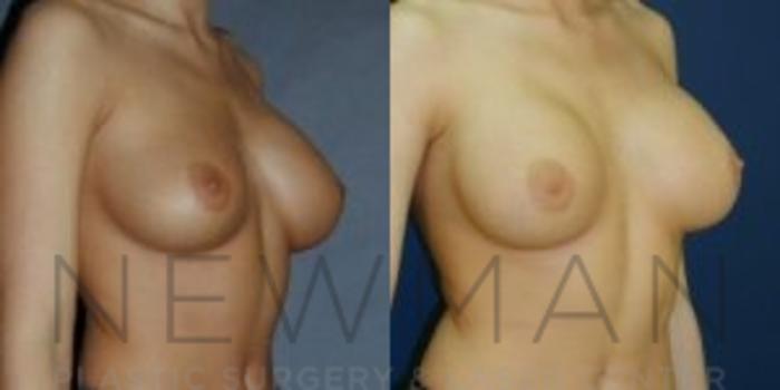 Before & After Breast Asymmetry Case 71 Right Oblique View in Westchester County & Long Island, NY