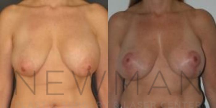 Before & After Breast Asymmetry Case 72 Front View in Westchester County & Long Island, NY