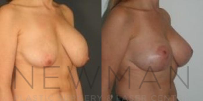 Before & After Breast Asymmetry Case 72 Right Oblique View in Westchester County & Long Island, NY