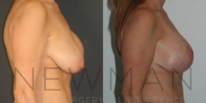 Before & After Breast Asymmetry Case 72 Right Side View in Westchester County & Long Island, NY