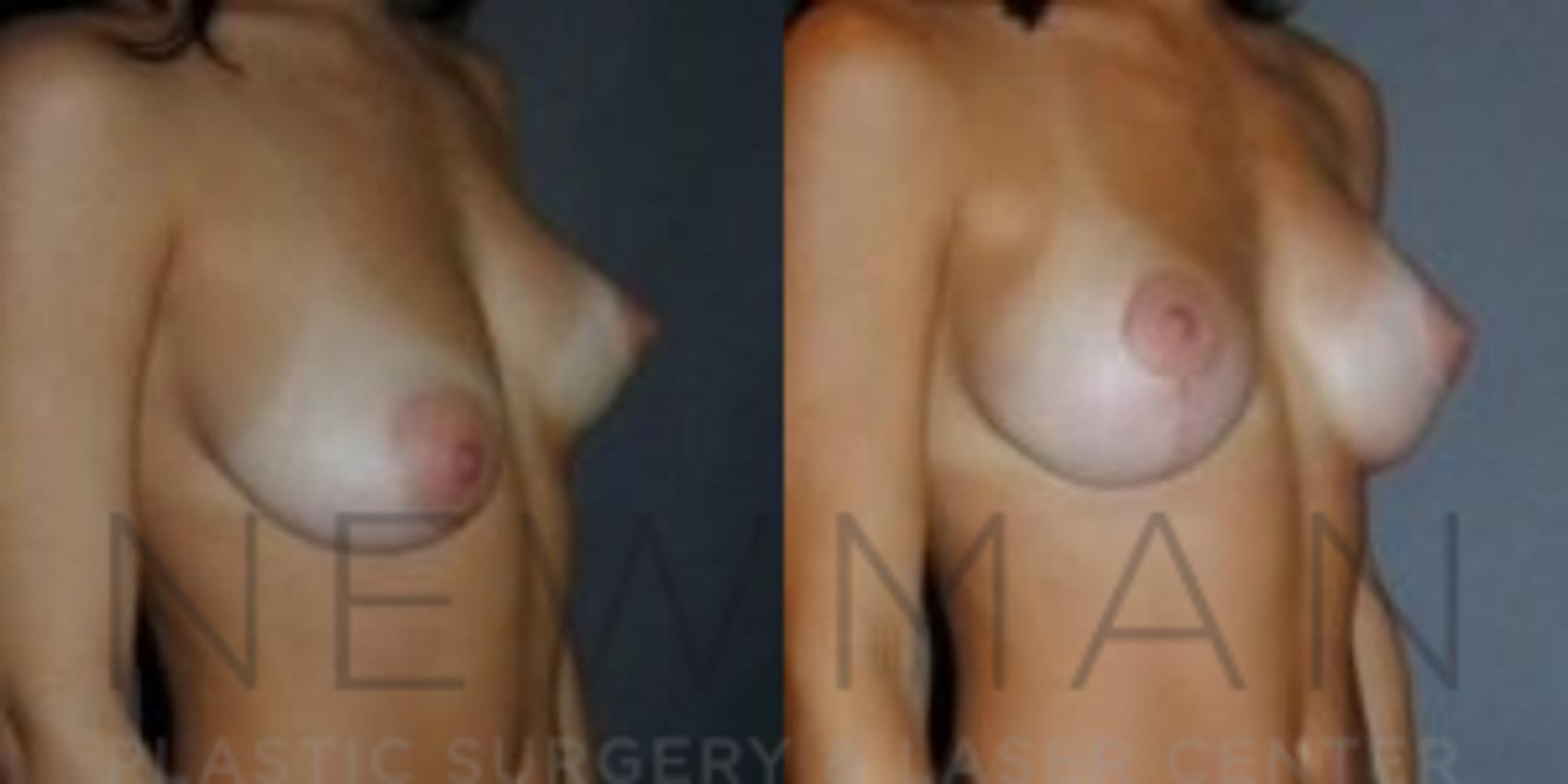 Before & After Breast Asymmetry Case 73 Right Oblique View in Westchester County & Long Island, NY