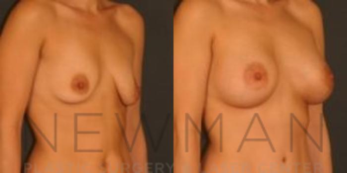 Before & After Breast Asymmetry Case 74 Right Oblique View in Westchester County & Long Island, NY