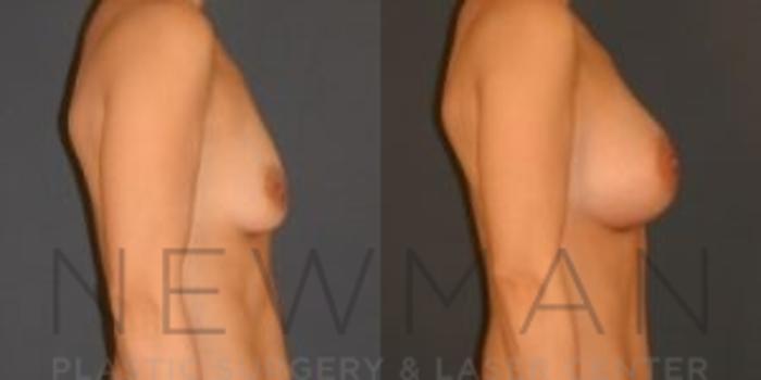 Before & After Breast Asymmetry Case 74 Right Side View in Westchester County & Long Island, NY