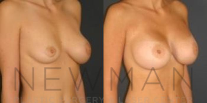Before & After Breast Asymmetry Case 75 Right Oblique View in Westchester County & Long Island, NY