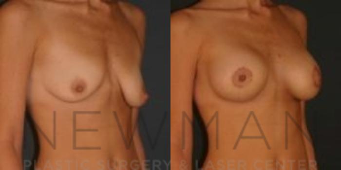 Before & After Breast Asymmetry Case 76 Right Oblique View in Westchester County & Long Island, NY