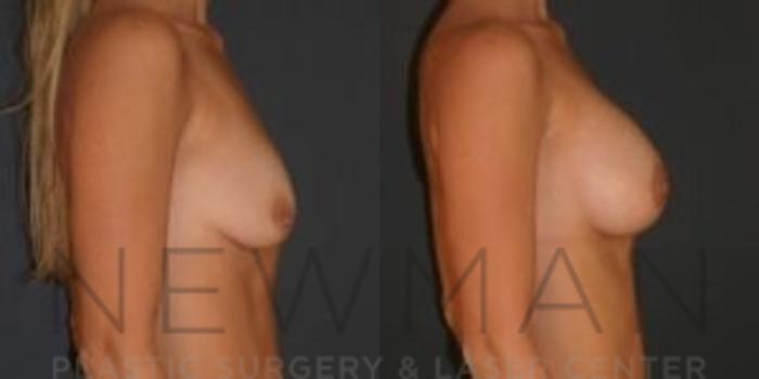 Before & After Breast Asymmetry Case 76 Right Side View in Westchester County & Long Island, NY