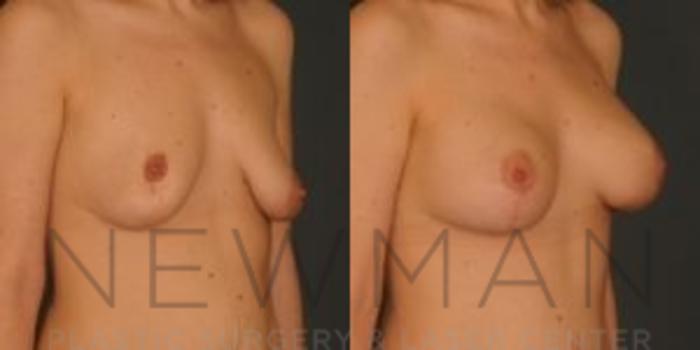 Before & After Breast Asymmetry Case 77 Right Oblique View in Westchester County & Long Island, NY