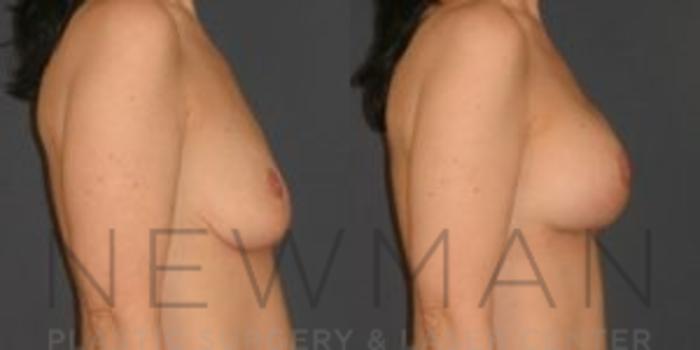 Before & After Breast Asymmetry Case 77 Right Side View in Westchester County & Long Island, NY
