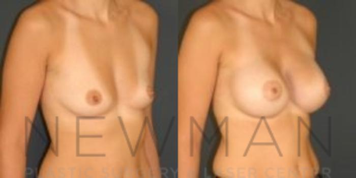 Before & After Breast Asymmetry Case 78 Right Oblique View in Westchester County & Long Island, NY