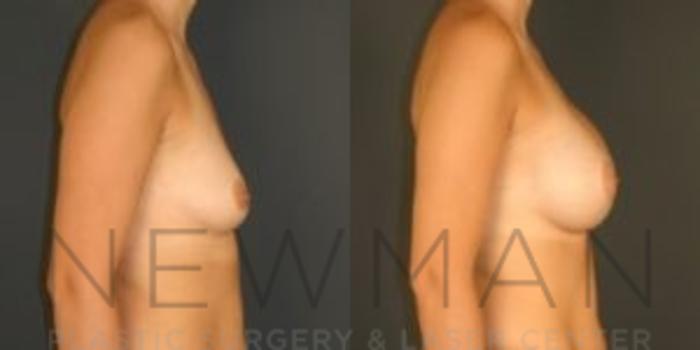 Before & After Breast Asymmetry Case 78 Right Side View in Westchester County & Long Island, NY