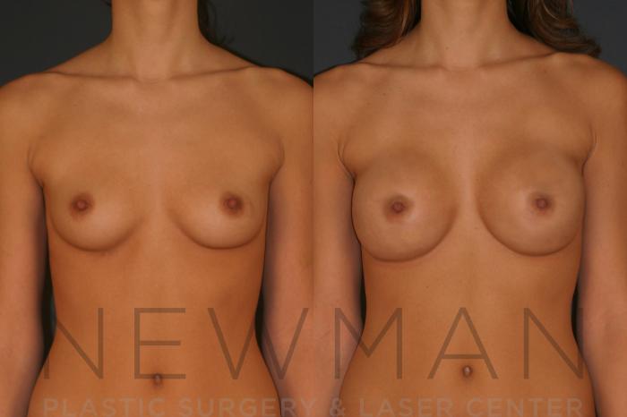 Before & After Breast Augmentation Case 10 Front View in Westchester County & Long Island, NY
