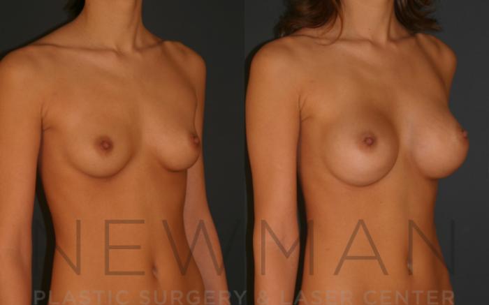 Before & After Breast Augmentation Case 10 Right Oblique View in Westchester County & Long Island, NY