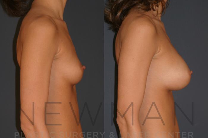 Before & After Breast Augmentation Case 10 Right Side View in Westchester County & Long Island, NY
