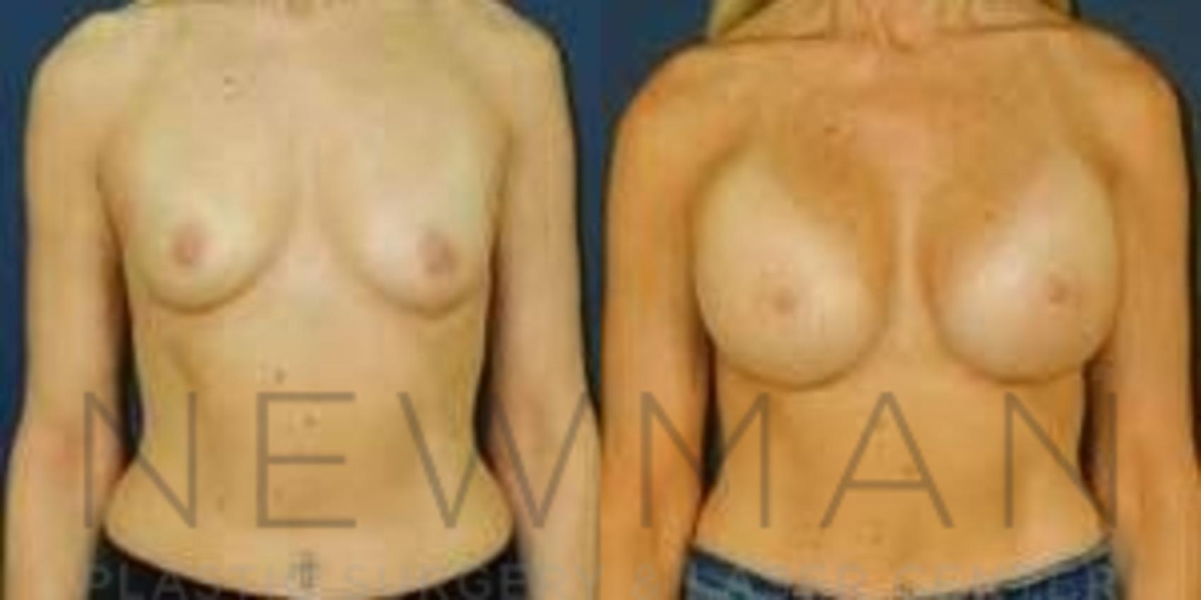 Before & After Breast Augmentation Case 101 Front View in Westchester County & Long Island, NY