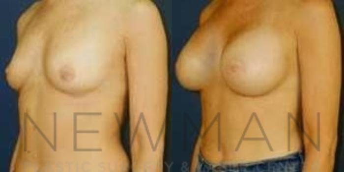 Before & After Breast Augmentation Case 101 Left Oblique View in Westchester County & Long Island, NY