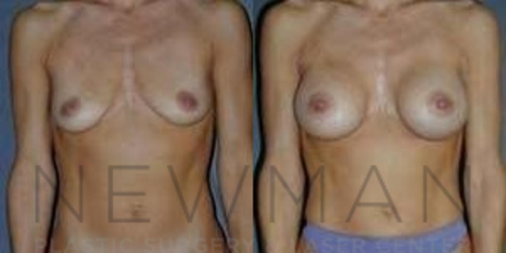 Before & After Breast Augmentation Case 102 Front View in Westchester County & Long Island, NY