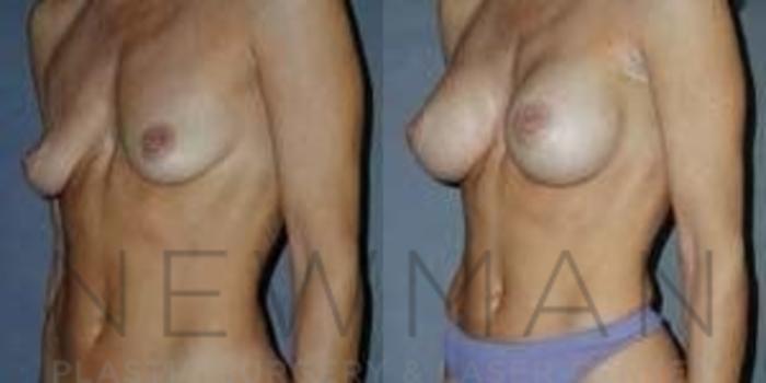 Before & After Breast Augmentation Case 102 Left Oblique View in Westchester County & Long Island, NY