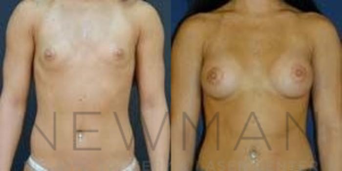 Before & After Breast Augmentation Case 103 Front View in Westchester County & Long Island, NY