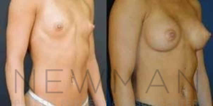 Before & After Breast Augmentation Case 103 Right Oblique View in Westchester County & Long Island, NY
