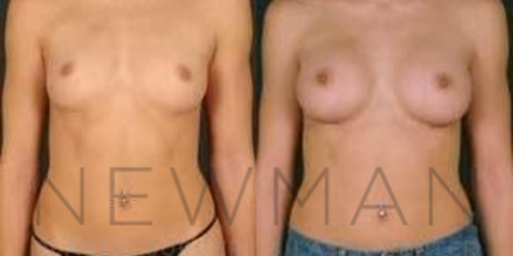 Before & After Breast Augmentation Case 106 Front View in Westchester County & Long Island, NY