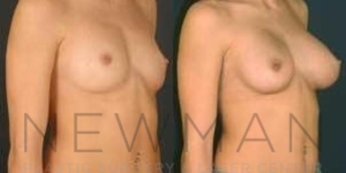 Before & After Breast Augmentation Case 106 Right Oblique View in Westchester County & Long Island, NY